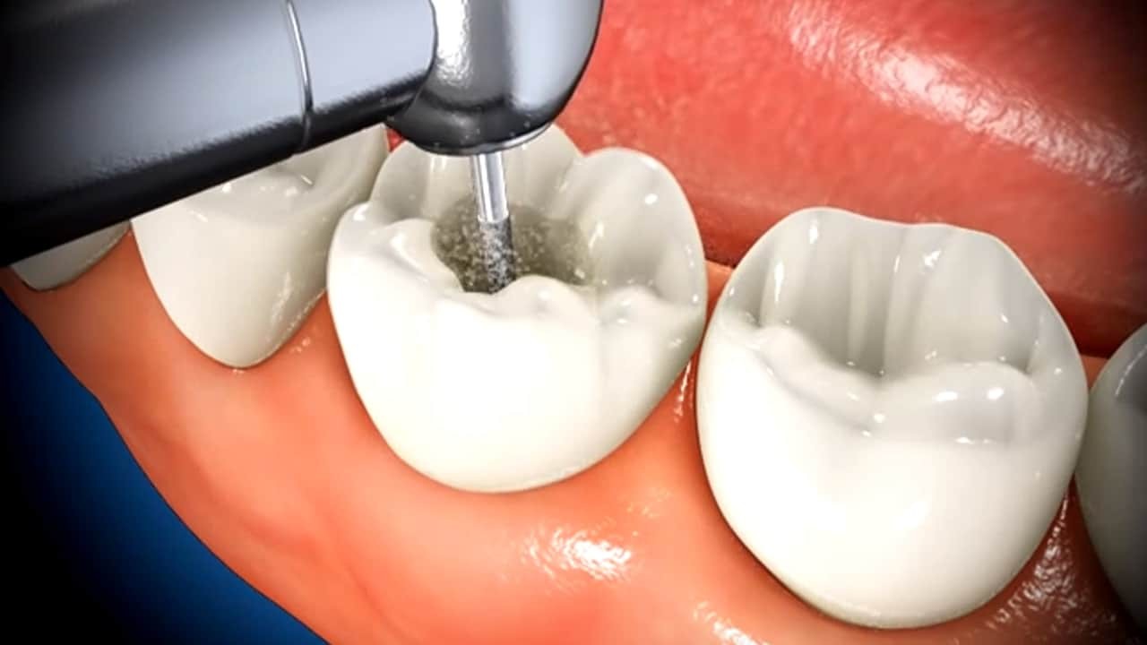 Endodonti (Kanal Tedavisi)